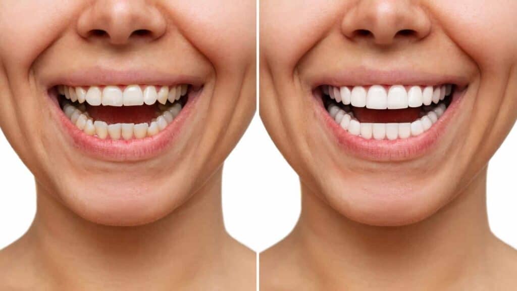 Before and after teeth whitening results. Dudley