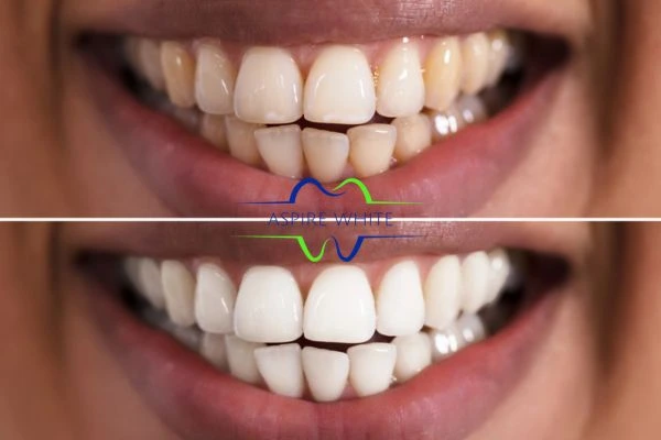 Aspire White customer before and after Dudley results.