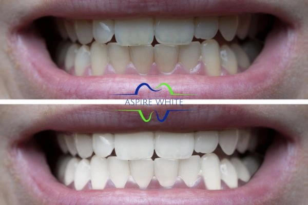1 hour laser teeth whitening before and after results Dudley