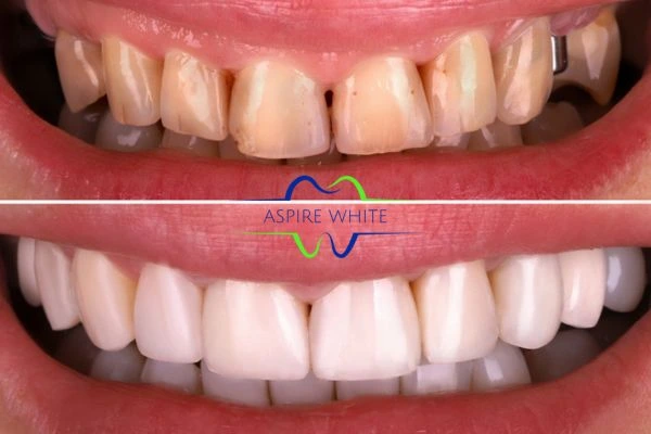 Yellow teeth results - 1 hour whitening before and after results Dudley