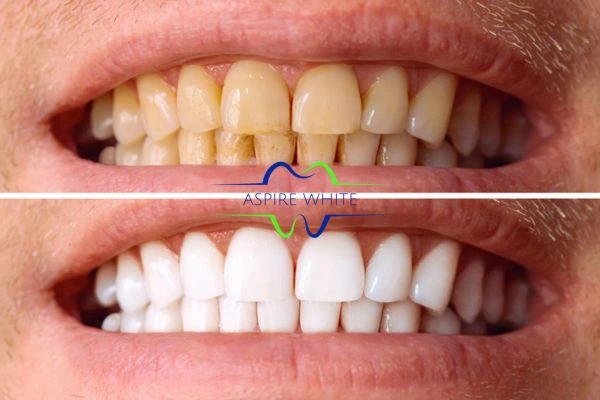 Get noticeable whiter smile in just one hour! Book your teeth whitening treatment Dudley today!
