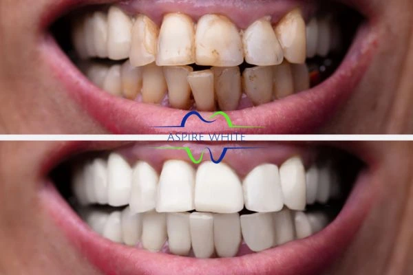 Before and after results of laser teeth whitening Dudley Book in online today!