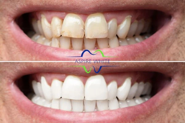 Achieve a radiant smile with professional laser teeth whitening Dudley